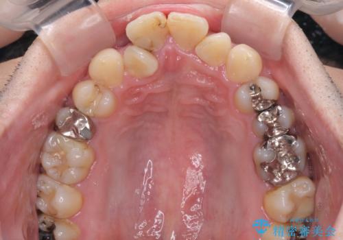 重なって磨きにくい上下の前歯 ワイヤー装置での抜歯矯正の治療前