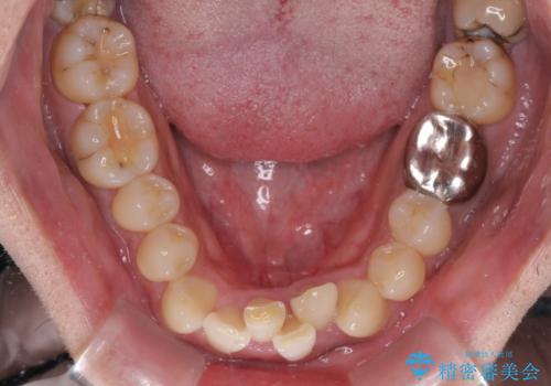 重なって磨きにくい上下の前歯 ワイヤー装置での抜歯矯正の治療前
