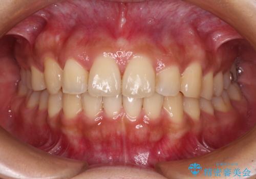 【モニター】歯列が狭くデコボコが気になる 急速拡大装置を用いたインビザライン矯正の治療中