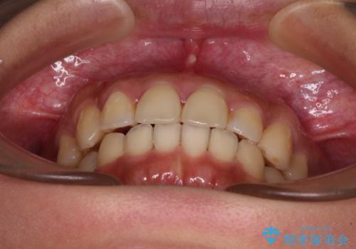 【モニター】歯列が狭くデコボコが気になる 急速拡大装置を用いたインビザライン矯正の治療中