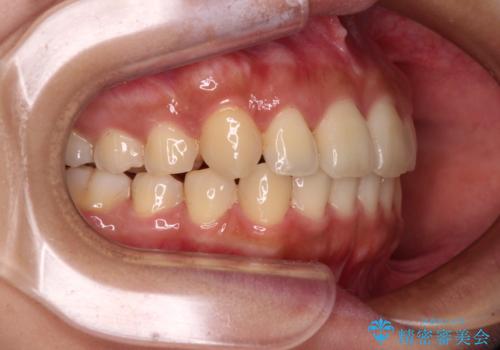 【モニター】歯列が狭くデコボコが気になる 急速拡大装置を用いたインビザライン矯正の治療中