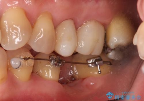 奥歯が割れた　インプラントは不向き　部分矯正後、ブリッジで治療の治療中