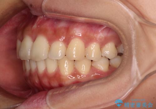 【モニター】歯列が狭くデコボコが気になる　急速拡大装置を用いたインビザライン矯正の治療中