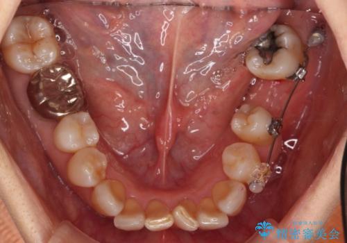 奥歯が割れた インプラントは不向き 部分矯正後、ブリッジで治療の治療中