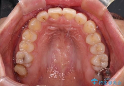 【モニター】歯列が狭くデコボコが気になる 急速拡大装置を用いたインビザライン矯正の治療中