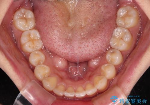 【モニター】歯列が狭くデコボコが気になる 急速拡大装置を用いたインビザライン矯正の治療中