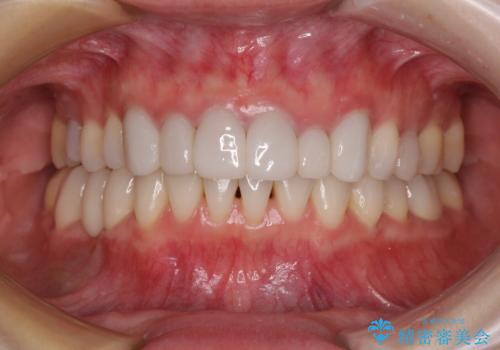 前歯のデコボコと奥歯の咬み合わせをインビザラインで改善の症例 治療後