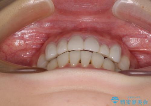 前歯のデコボコと奥歯の咬み合わせをインビザラインで改善の治療後