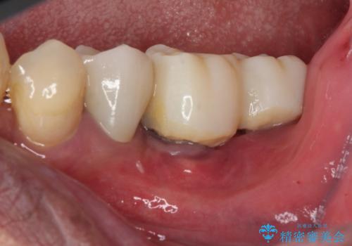 追加のインプラントと、歯肉移植による磨きやすい歯肉に改善の治療前
