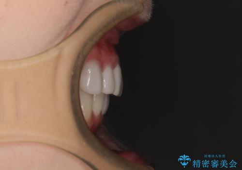 前歯のデコボコと奥歯の咬み合わせをインビザラインで改善の治療後