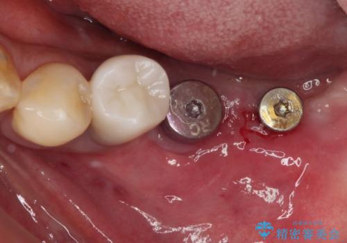 追加のインプラントと、歯肉移植による磨きやすい歯肉に改善の治療前