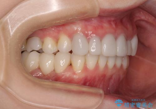 前歯のデコボコと奥歯の咬み合わせをインビザラインで改善の治療後