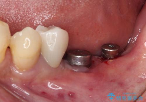 追加のインプラントと、歯肉移植による磨きやすい歯肉に改善の治療中