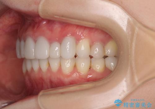 前歯のデコボコと奥歯の咬み合わせをインビザラインで改善の治療後