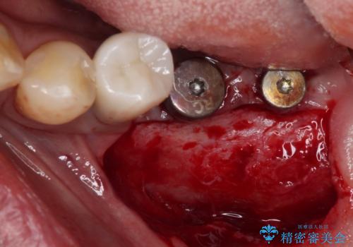 追加のインプラントと、歯肉移植による磨きやすい歯肉に改善の治療中
