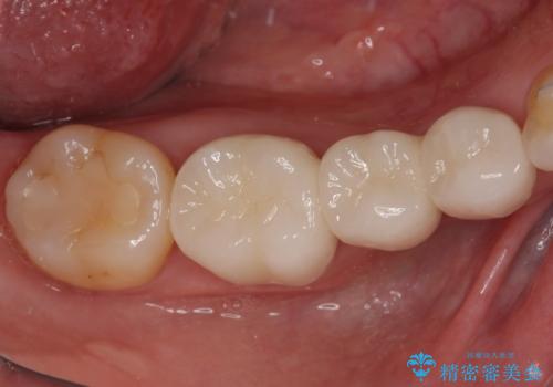 前歯のデコボコと奥歯の咬み合わせをインビザラインで改善の治療後
