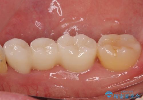 前歯のデコボコと奥歯の咬み合わせをインビザラインで改善の治療後