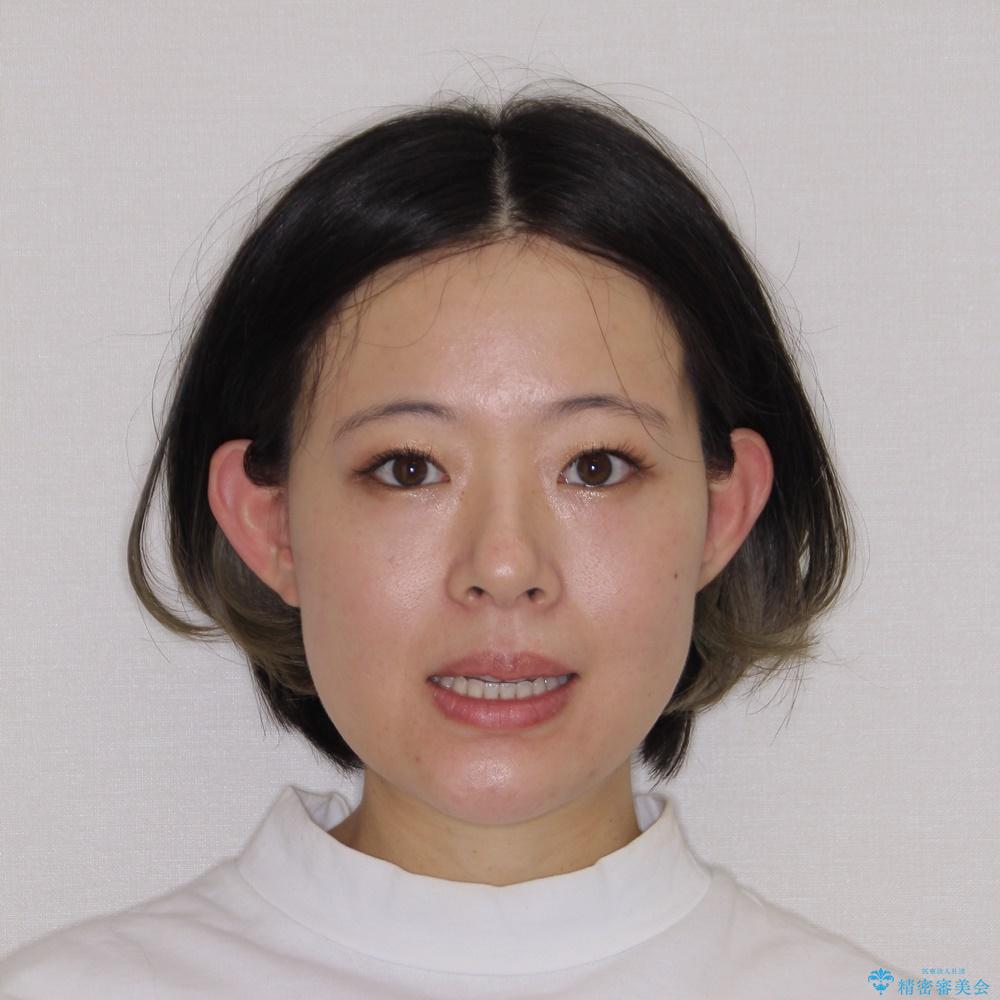 【モニター】狭い上顎歯列とオープンバイト　急速拡大装置を用いた矯正治療の治療前（顔貌）