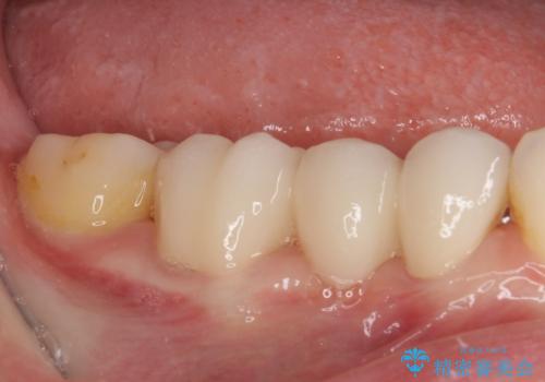 前歯のデコボコと奥歯の咬み合わせをインビザラインで改善の治療後