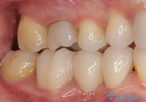 前歯のデコボコと奥歯の咬み合わせをインビザラインで改善の治療後