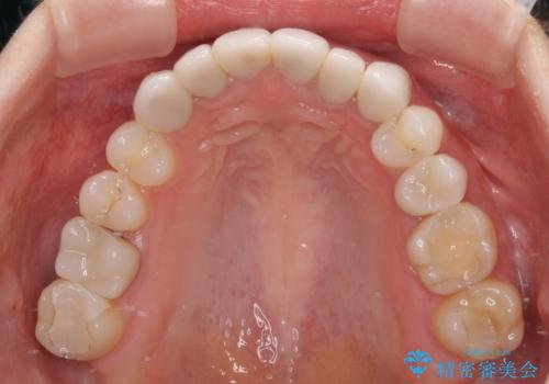 前歯のデコボコと奥歯の咬み合わせをインビザラインで改善の治療後
