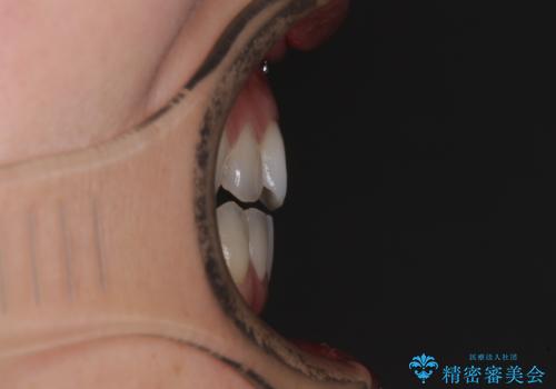 【モニター】狭い上顎歯列とオープンバイト 急速拡大装置を用いた矯正治療の治療前