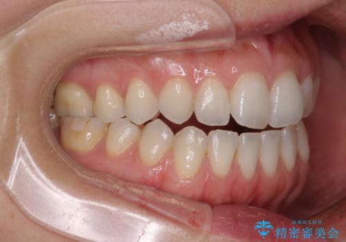 【モニター】狭い上顎歯列とオープンバイト　急速拡大装置を用いた矯正治療の治療前