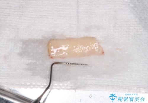 追加のインプラントと、歯肉移植による磨きやすい歯肉に改善の治療後