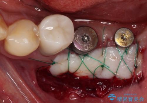 追加のインプラントと、歯肉移植による磨きやすい歯肉に改善の治療前