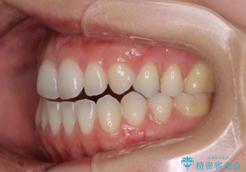 【モニター】狭い上顎歯列とオープンバイト 急速拡大装置を用いた矯正治療の治療前