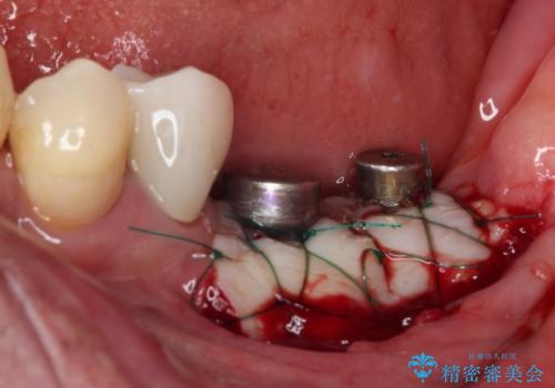 追加のインプラントと、歯肉移植による磨きやすい歯肉に改善の治療後