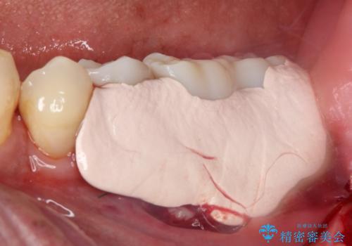 追加のインプラントと、歯肉移植による磨きやすい歯肉に改善の治療前