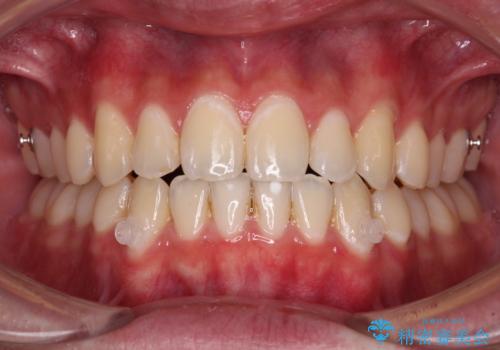 受け口傾向の咬み合わせ インビザラインできれいな口元にの治療中