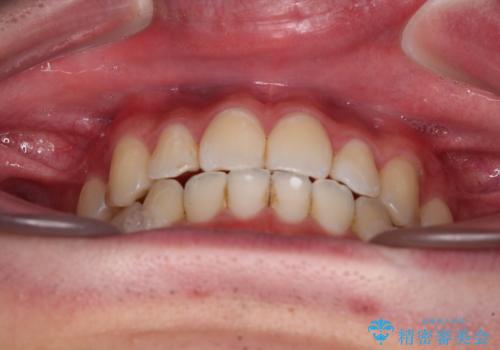 受け口傾向の咬み合わせ インビザラインできれいな口元にの治療中