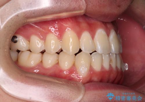 受け口傾向の咬み合わせ インビザラインできれいな口元にの治療中