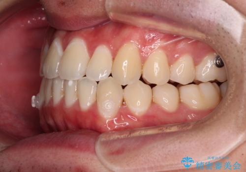 受け口傾向の咬み合わせ インビザラインできれいな口元にの治療中