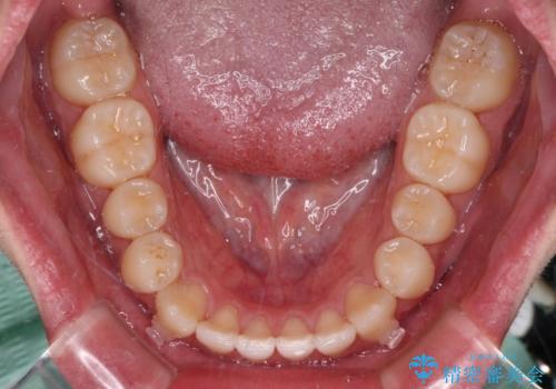 受け口傾向の咬み合わせ インビザラインできれいな口元にの治療中