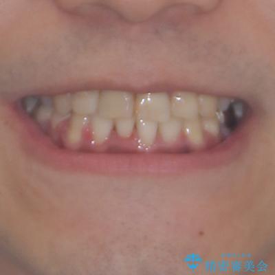 重なって磨きにくい上下の前歯 ワイヤー装置での抜歯矯正の治療後(顔貌)