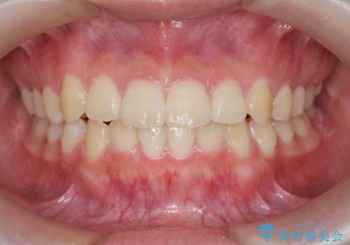 インビザラインで行う八重歯の治療の治療後