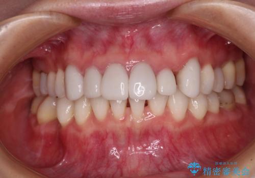前歯のデコボコと奥歯の咬み合わせをインビザラインで改善の治療中