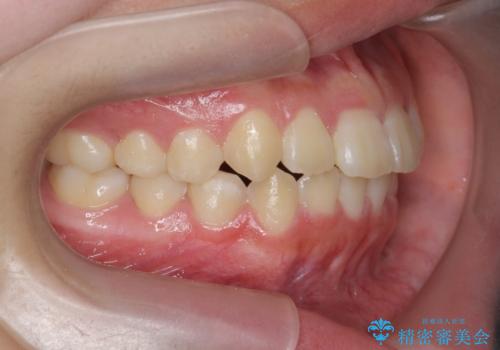 インビザラインで行う八重歯の治療の治療後