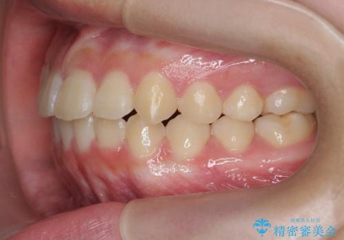 インビザラインで行う八重歯の治療の治療後