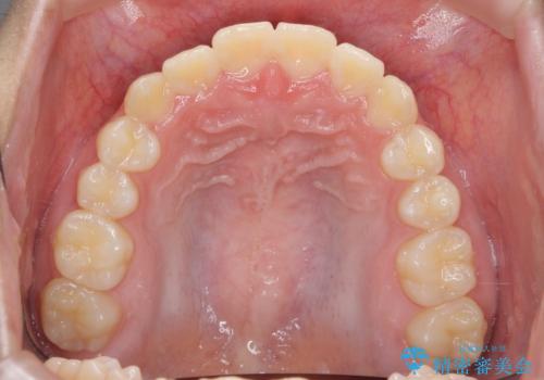 インビザラインで行う八重歯の治療の治療後