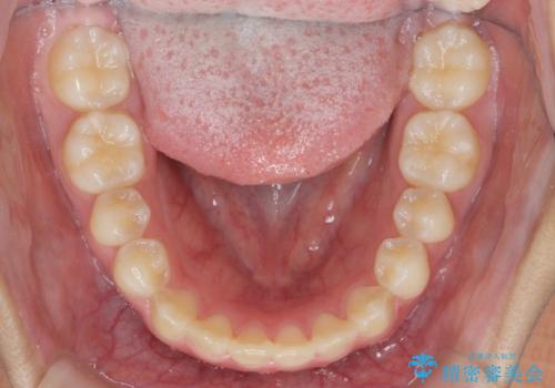 インビザラインで行う八重歯の治療の治療後