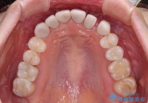 前歯のデコボコと奥歯の咬み合わせをインビザラインで改善の治療中