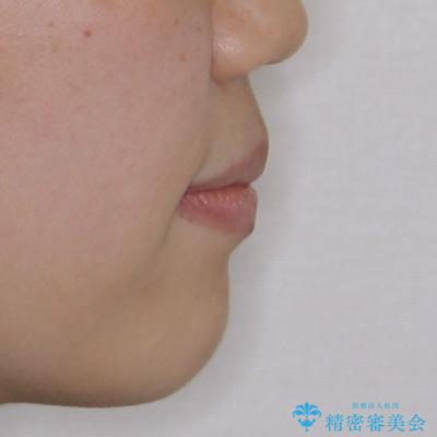 大学病院から転院 非抜歯で口元を下げるワイヤー矯正の治療後(顔貌)