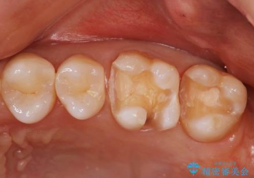 メタルフリーにしたい。の治療中