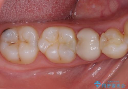 欠けてしまったプラスチック オールセラミッククラウンで土台の歯を守るの治療前