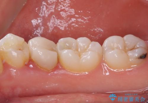 欠けてしまったプラスチック オールセラミッククラウンで土台の歯を守るの治療前