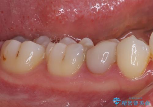 欠けてしまったプラスチック オールセラミッククラウンで土台の歯を守るの治療前